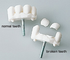 Damage of front teeth