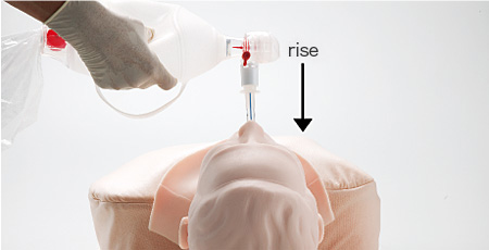 Confirmation of Mistakenly Intubated Air Possible